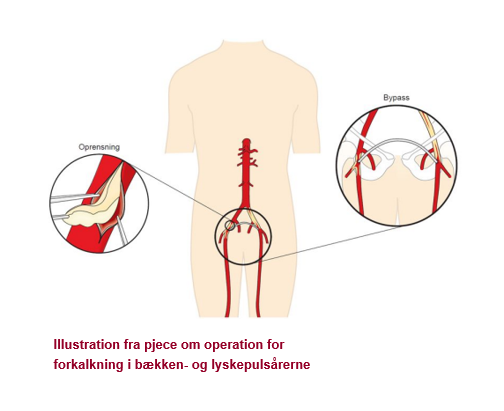 Illustration fra pjece om operation for forkalkning i bækken- og lyskenpulsårerne